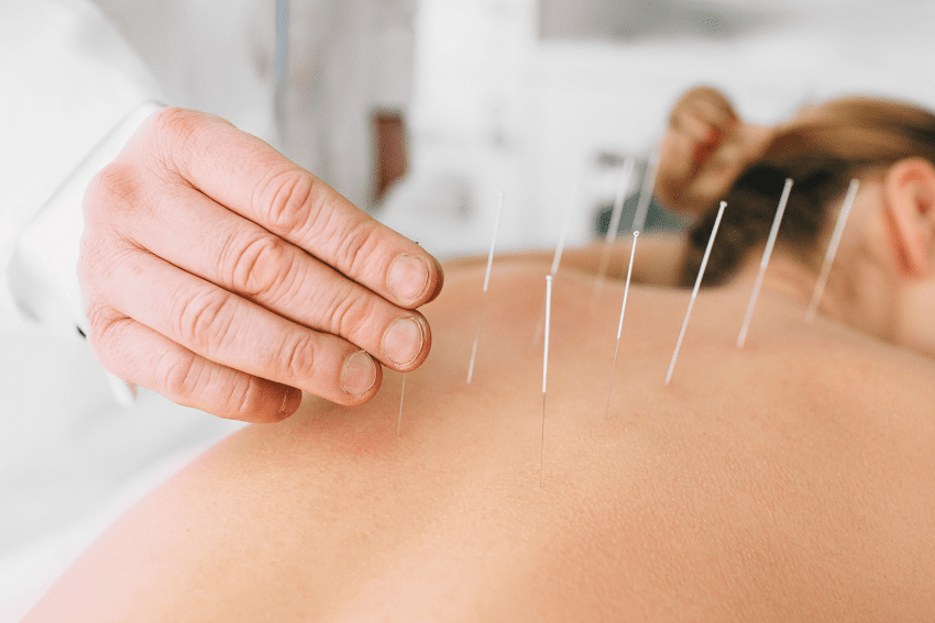 Acupuncture in Stoney Creek and Hamilton